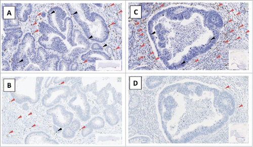 Figure 1. Example of slides of FoxP3 and CD8 labeling A and C: CD8+ labeling, B and D: FoxP3+ labeling, A and B patient N°1; C and D: patient N°2, red arrow: sTILs (stromal Tumor-Infiltrating Lymphocytes), black arrow: iTILS (intraepithelial Tumor-Infiltrating Lymphocytes).