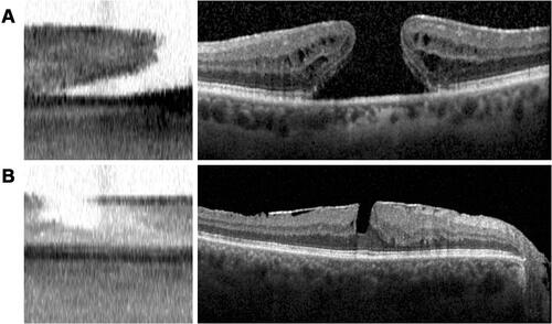 Figure 5 Macular hole appearance on swept-source and spectral-domain OCT. (A and B, left) IOLMaster 700 SS-OCT scans of two different eyes with macular holes. (A and B, right) Corresponding Spectralis SD-OCT scans of macular holes.