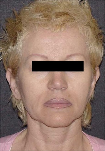 Figure 4 Image of a 55-year-old woman who has undergone facelift and upper blepharoplasty.