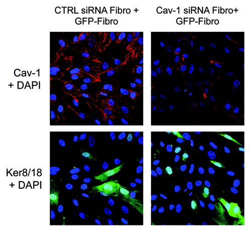 Figure 12. Cav-1-deficient fibroblasts induce the downregulation of Cav-1 in normal adjacent fibroblasts, when the two fibroblasts subtypes are co-cultured. hTERT-GFP(+) fibroblasts and hTERT-GFP(-) fibroblasts (transfected with Cav-1 siRNA or control siRNA) were co-cultured for 72 h. Note that the presence of GFP(-) fibroblasts harboring Cav-1 siRNA induces the loss of Cav-1 in surrounding normal GFP(+)-fibroblasts, suggesting that loss of Cav-1 can also exert its effects at a distance, creating a Cav-1-deficient field of fibroblasts. Cells were then fixed and immunostained with an anti-Cav-1 (red) antibody and green fluorescence in the BJ-1-GFP cells was detected (green). Cav-1 staining (red) is shown in the top panels, and GFP (which marks BJ-1 cells not treated with siRNA) and DAPI (as a nuclear counterstain) are shown in the bottom panels. Original magnification, 40x.