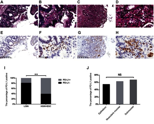 Figure 2 The expression of PD-L1 and its association with stage in LGIN, HGIN, and EGC. (A–H) The representative expression of PD-L1 in LGIN (A, B, E, F), HGIN+EGC (C, D, G, H); shown at ×100 (A, C, E, G) and ×400 (B, D, F, H) original magnification; (I) The correlation between stage and PD-L1 expression, which was determined using χ2 test; (J) The correlation between the depth of invasion and PD-L1 expression, which were also determined using the Spearman’s rank correlation coefficient test.Note: **P<0.01.Abbreviations: EGC, early-stage gastric cancer; HGIN, High-grade Intraepithelial neoplasia; LGIN, Low-grade Intraepithelial neoplasia; NS, not statistically significant; PD-L1, programmed death-ligand 1.