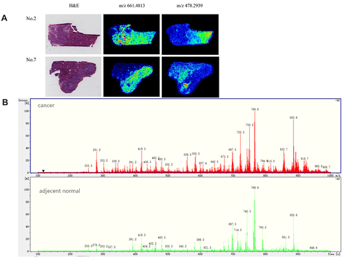 Figure 2 Representative H&E staining and in situ ion images of lipid metabolites. (A) Representative H&E staining (from Patient 2 and Patient 7) are shown in left panel, with the cancerous area circled with red line. In situ ion images of lipid metabolites are shown in right panel. MSI data were acquired with the spatial resolution of 200 mm. (B) Mass spectra of representative cancer and normal regions.