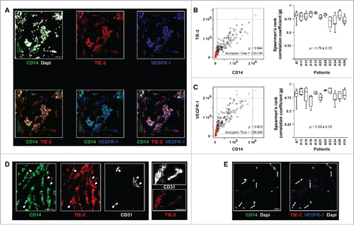 Figure 1. In human breast tumors, TEM can be identified solely based on CD14 immunostaining. (A) Immunofluorescence staining and confocal analysis of human BC tumor sections showing CD14, TIE-2 and VEGFR-1 triple positive cells. Representative image from 16 patients; (B) CD14 and TIE-2 expression correlation analysis. The dot plot (left panel) represents all tiles for one representative image; the box plot (right panel) shows the Spearman’s rank correlation coefficient (ρ) for CD14 and TIE-2 expression in 11 patients. In the dot plot, 54% of CD14+ tiles and 70% of TIE-2+ tiles were above the threshold. 100% of CD14+ tiles were TIE-2+ which means that the high correlation (ρ = 0.844) applied to all CD14+ tiles; (C) CD14 and VEGFR-1 expression correlation analysis for 11 patients. In the dots plot, 55% of CD14+ tiles and 75% of VEGFR-1+ tiles were above the threshold. 100% of CD14+ tiles are VEGFR-1+ which means that the high correlation (ρ = 0.852) applied to all CD14+ tiles; (D) Example of TIE-2 expression in TEM, clusters of BEC (arrow heads) and blood vessels (right panel) shown in confocal microscopy images of BC sections. TEM and blood endothelial structures were stained with CD14 and CD31, respectively; (E) Example of immunofluorescence labeling of CD14, VEGFR-1 and TIE-2 in sections containing non-neoplastic breast tissue adjacent to tumor tissues. CD14+ cells (arrows) are VEGFR- and TIE-2-. Non-neoplastic (panel E) and tumor tissue (panel A) were stained and imaged simultaneously under the same conditions and thus intensities of the expression of TIE-2 and VEGFR-1 signals can be compared. Representative images from four patients. Scale bars: 25 μm.