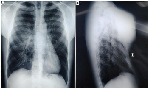 Figure 3 The patient’s chest radiography.