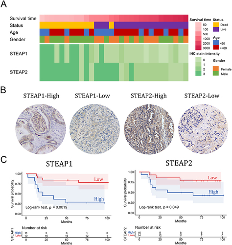 Figure 5 Associations between STEAP1 and STEAP2 protein levels and the prognosis in LUAD patients. (A) Heatmaps show the IHC staining results of STEAP1 and STEAP2 of 30 LUAD patients as well as corresponding clinical features. (B) Representative immunohistochemistry images of LUAD tissue with higher or lower STEAP1/2 expression level (×200). (C) The Kaplan–Meier plots of the overall survival in LUAD patients with higher or lower STEAP1 and STEAP2 expression levels according to IHC staining scores. P-values derived from the Log rank tests were labeled.
