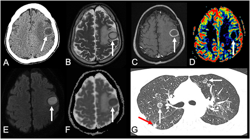 Figure 6 A 45-year-old man presented with seizures. Brain CT showed an hypodense lesion in the left frontal lobe, with peripheral edema (arrow in (A)). Brain MRI showed an expansive lesion with hyperintense signal on its central part and a peripheral hypointense signal, surrounded by edema, on T2-weighted imaging (arrow in (B)). T1-weighted imaging after intravenous gadolinium injection demonstrated a peripheral and thin enhancement in the lesion (arrow in (C)). PWI demonstrated a reduced rCBV (arrow in (D)). (E and F) Diffusion-weighted imaging and apparent diffusion coefficient map demonstrated that the lesion had a central area of diffusion restriction, suggestive of an abscess (arrows in (E and F), respectively). Chest CT demonstrated areas of reversed halo sign (white arrows in (G)) and nodules (red arrow in (G)). The histopathological analysis of the brain lesion confirmed PCM.