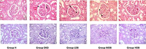 Figure 7 H&E and PAS images from kidney of rats in different groups.Note: The arrows show mesangial expansion and hyper-cellularity and the arrow heads show GBM wrinkling and thickening. Abbreviations: H, healthy control; DKD, diabetic kidney disease control; LDB, low dose of BCc1; MDB, medium dose of BCc1; HDB, high dose of BCc1.