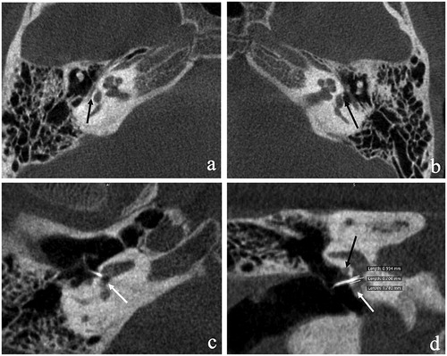 Figure 2. Cone-bean CT at 1 month after surgery. Axial section showing the absence of oval window (black arrow) with the facial nerve occupying the vestibular area in the affected side (a) vs. the normal oval window in the unaffected side (black arrow) (b). The stapes prothesis was inserted into the scala tympani along the superior margin of the round window (c) and the white arrow showed the round window niche. From the coronal image section, the length of protrusion was scaled (d).