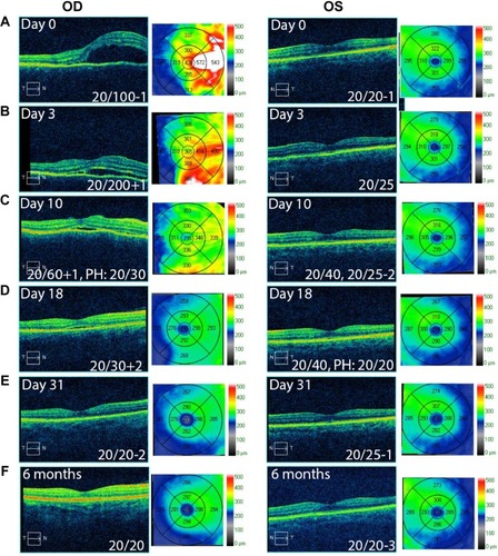 Figure 5 OCT studies of Case 3.