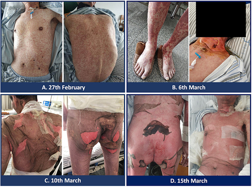 Figure 1 Clinical photograph of the patient demonstrating erythematous plaques and desquamation. (A) On February 27, 2020, the patient developed red rashes on the upper limbs, the front chest, and the back. The rashes were slightly raised above the skin and were not accompanied by itching. (B) On March 6, 2020, the patient’s blisters around the mouth, back, and limbs progressed more than before, and the skin on the neck began to peel off. (C) On March 10, 2020, the patient experienced skin peeling on the head, neck, back, and buttocks, with significant pain, and new blisters appeared on the lower limbs. (D) On March 15, 2020, the patient’s skin peeling worsened. Skin peeling was also observed on the external genitalia and around the anus, with bright red skin exposed, accompanied by exudation.