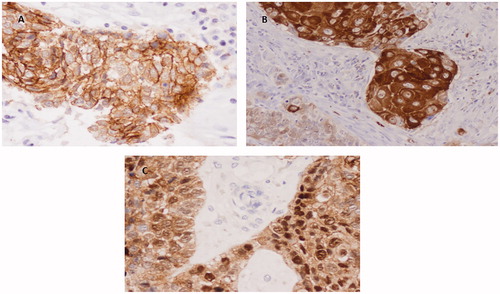 Figure 1. Immunohistochemical staining of PKP1 in SCC. (A) Predominant staining in cell membrane a (40×). (B) Positivity in membrane and cytoplasm. Note weak staining in less differentiated area (bottom left) (20×). (C) Nuclear staining (40×).