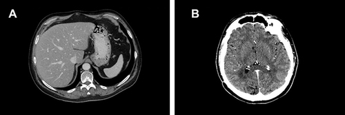 Figure 6 (A) Hepatic complete response and (B) stable brain disease after 31 months of therapy with ribociclib.