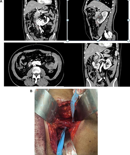 Figure 1 (A) CT-scan image – axial, coronal and sagittal sections (C stands for left side renal cyst, U is dilated right proximal ureter located lateral and behind the IVC, A is aorta, s stands for the stone in the right proximal dilated ureter and I is inferior vena cava). (B) Intraoperative image of retrocaval ureter.