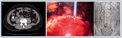 Figure 1. Approximately 30 mm calculus in the renal pelvis of malrotated right kidney (A); renal access was performed directly into the renal pelvis under laparoscopic and fluoroscopic control (B); complete stone clearence achieved and a double-J stent was inserted (C) 301 × 94mm (96 × 96 DPI).