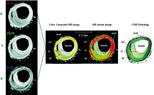 Figure 2. Illustration of the spatially enhanced iterative cluster analysis for the multi‐contrast ex vivo magnetic resonance (MR) images of human coronary artery specimens. On the left are shown the T1‐, proton density, and T2‐weighted (T1W, PDW and T2W, respectively) axial plane images that were assigned red (R), green (G), and blue (B) colours, respectively, and combined to yield a colour composite and pseudo‐colour cluster image of the coronary artery with colour distributions corresponding to different tissue types. On the right a comparable histopathology image via a combined Masson's elastic (CME) stain is shown. This type Vb‐Vc lesion exhibits eccentric fibrous deposits and a dark area of calcification. The identified areas include dense fibrous tissue (df), calcium deposits (cal), media (med), and fibrous cap (fc). The CME histopathology shows an excellent agreement with the MR images. (With permission from Itskovich et al. 2004 Citation21.)