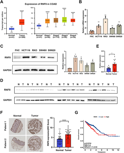 Figure 1 RNF8 is overexpressed in colon cancer. (A) Expression levels of RNF8 in colon cancer samples and normal samples in TCGA database based on sample type or tumor stage, respectively. (B) The expression of RNF8 in normal colonic epithelial cell FHC and four colon cancer cell lines was analyzed by RT-PCR. (C) Western blot analysis of RNF8 expression in the above five cell lines. (D and E) The expression levels of RNF8 in colon cancer samples and adjacent tissues were analyzed by Western blot (N: Normal T: Tumor). (F) Immunohistochemical analysis and representative images of 45 pairs of colon cancer samples and corresponding adjacent tissues, performed using anti-RNF8 antibodies and re-stained with hematoxylin. (G) Kaplan-Meier survival analysis showed that colon cancer patients with high RNF8 expression had a worse prognosis than those with low RNF8 expression. Data were obtained from The Human Protein Atlas (https://www.proteinatlas.org/). * represents p<0.05, whereas ** and **** represent p<0.01 and p<0.0001, respectively.