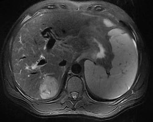Figure 1 Liver MRI image of a patient in the First Affiliated Hospital of Anhui Medical University, Hefei, China.