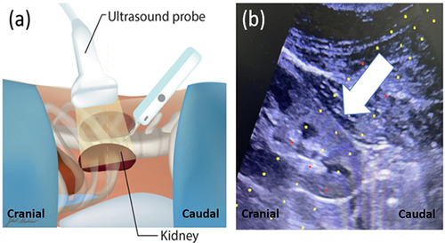 Figure 2 (a) Cranial direction of the needle with ultrasonogram probe, in which the tip of the needle angulated toward the head. (b) Ultrasonogram imaging of caudal direction technique showing the needle trajectory line and target area of the biopsy. The white arrow indicates the direction of the biopsy needle.
