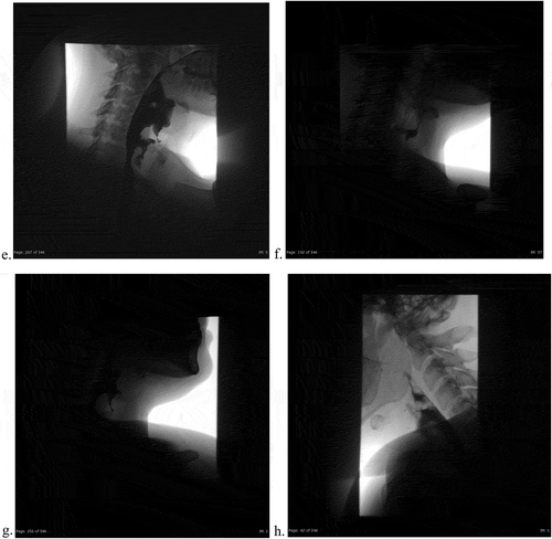 Figure 3b. (eh). Post-endoscopy single contrast esophagram. Lateral views using gastrografin, with attention to the vallecula and the diverticulum. Extrinsic impression and rightward deviation of the esophagus with extravasation of contrast around level of C6-C7. 3 H is a static image demonstrating normal morphology of the mucosa