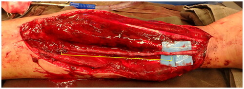 Figure 5. The vein graft was used to reconstruct the vascular defect (Yellow segment).