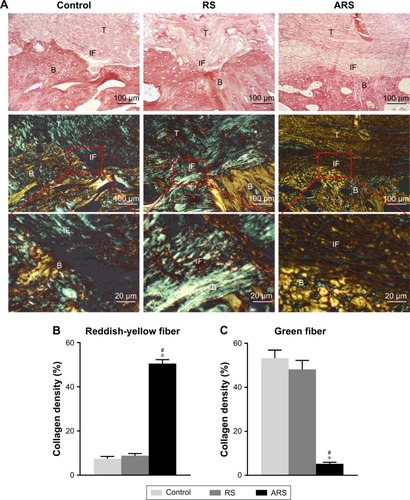 Figure 4 Results of Picrosirius red staining evaluation of the control group, the RS group, and the ARS group at 12 weeks after surgery.Notes: (A) Images observed under normal condition are shown on the first row. Corresponding sections observed under polarizing condition are shown on the second row. Partial magnifications of the red rectangle area are displayed on the third row. Collagen density analysis includes the reddish-yellow fiber area/total tendon area ratio (B) and the green fiber area/total tendon area ratio (C). The collagen fibers are most mature in the ARS group at 12 weeks after surgery. *P<0.05 vs control, #P<0.05 vs RS group.Abbreviations: T, tendon; B, bone; IF, interface; RS, random scaffold; ARS, aligned-random scaffold.