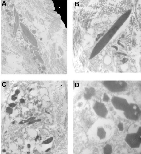 Figure 3 Electron microscopy of the corneal biopsy specimen.