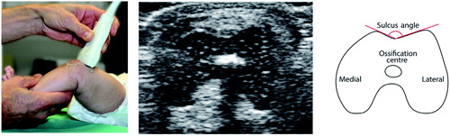 Figure 1. Collage demonstrating ultrasound examination of the knee of a 3-month-old girl, with a corresponding ultrasound screenshot and a line diagram for illustration of the sulcus angle (SA). With the knee flexed above 45° and the transducer held in a transverse plane perpendicular to the axis of the femoral diaphysis, an image of the femoral condyles with the trochlea was produced. The femoral ossification center is visible.