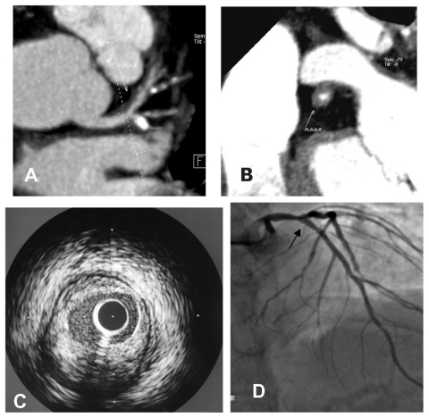 Figure 3 Images from a 45-year-old male patient with typical angina. A) shows a noncalcified plaque located in the left main coronary artery leading to significant stenosis see on dual-source computed tomography. B) Corresponding crosssection of the same plaque on dual-source computed tomography. C) Intravascular ultrasound indicating that the major composition of this plaque was fibrosis. D) Coronary angiography indicating a significant stenosis located in the left main coronary artery near to bifurcation.