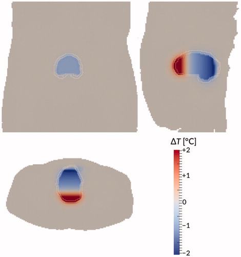 Figure 10. Temperature difference between the dynamic model and the ‘perfect mixing’ model (‘perfect mixing’ minus dynamic) after 90 min treatment time for patient #12. Bladder wall shown in white. Shown are a coronal view (top right), sagittal view (top left), and axial view (bottom) through the centre of gravity of the bladder. Gravity points into the paper, to the left, and to the bottom, respectively.