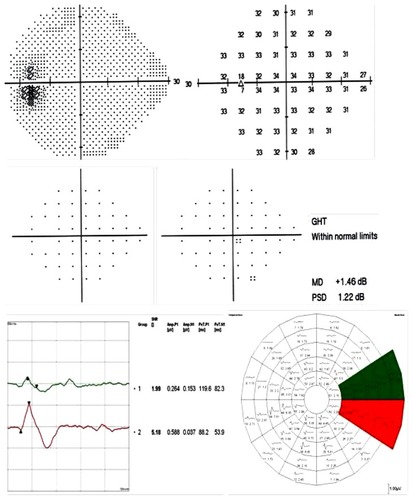 Figure 11 A SITA standard 24-2 test and mfVEP test with HSA printout for a glaucoma suspect patient without any significant field defects.