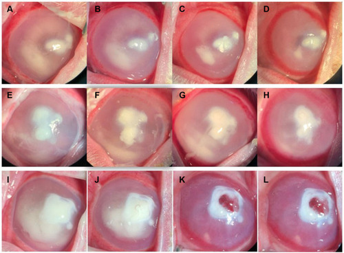 Figure 3 Representative slit-lamp pictures of the CTOIDD-NVCM group (A–D), Eye drop group (E–H), CTOIDD-saline group (I–L). Pictures were taken on days one (A, E, I), two (B, F, J), four (C, G) and eight (D, H, L). Eyes in the CTOIDD-saline group presented a remarkable corneal edema and infiltration, conjunctival hyperemia and hypopyon. A typical corneal perforation with hyperemic iris incarceration on day six was observed in the CTOIDD-saline group (K). The eyes on day eight in the CTOIDD-NVCM and eye drop groups appeared less inflamed.