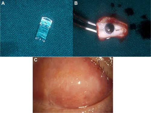 Figure 8 OOKP lamina and postoperative course after stage 1.