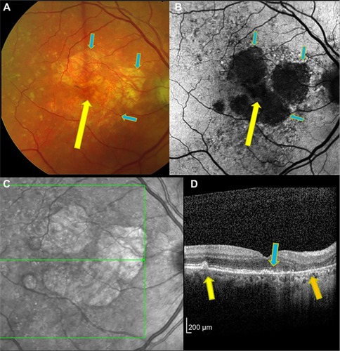 Figure 1 Right eye of patient with drusen-associated GA imaged by color photograph (A), fundus autofluorescence (B), infrared reflectance (C), and OCT (D).