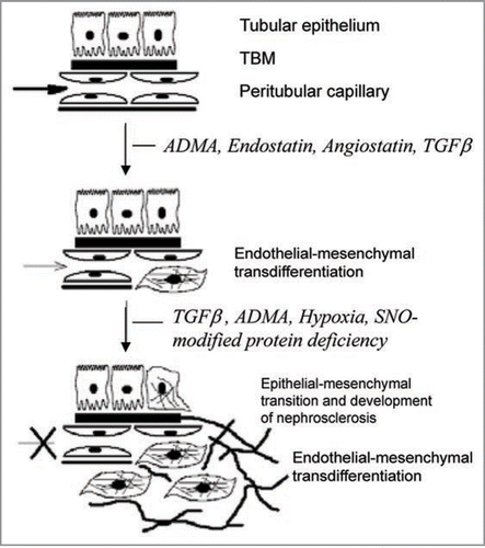 Figure 4 A hypothetical schema depicting the contribution of elevated guanidino compound, asymmetric dimethylarginine (ADMA), and downstream production of endostatin and TGFbeta to endothelial-mesenchymal transition, loss of vessel patency and fibrogenic transformation.