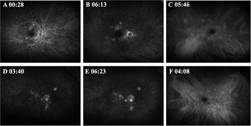 Figure 7. Fluorescein angiography and Indocyanine Green Angiography (ICG) on initial presentation of Patient 2. FA showed window defects in areas with RPE atrophy without vascular leakage in the right eye (A, B) and the left eye (D, E). ICG revealed multifocal hypercyanescent areas with a few hypocyanescent spots in the right eye (C) and the left eye (F).