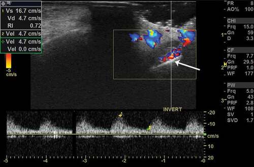Figure 2. Color Doppler imaging in a patient with PANDO. Note the color scale calibrations and enhanced flow volumes. Vs – peak systolic velocity, Vd – end-diastolic velocity and RI – resistivity index. Note a comparatively high RI values in PANDO. The arrow demonstrates the lacrimal sac and its tip corresponds to the sac wall. Note the thickened wall. The graph below the image represents arterial spectral waveform which shows high systolic peaks (yellow +1 mark) and follow through diastole (yellow +2 mark)