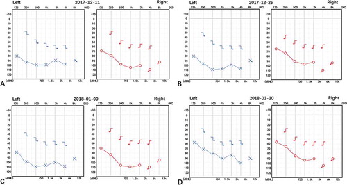 Figure 2. Pure tone audiometry showed bilateral sensorineural hearing loss. Figure A, B, C and D showed the pure tone audiometry performed by the patient on December 11, 2017, December 25, 2017, January 9, 2018 and March 30, 2018 respectively. Blue for left ear and red for right ear. The range of pure-tone in normal people is between 0 dB and 25 dB. The patient’s bilateral ears had pure-tone averages of greater than 70 dB for air conduction (125 to 8000 Hz), which was classified as severe hearing loss according to the WHO classification criteria
