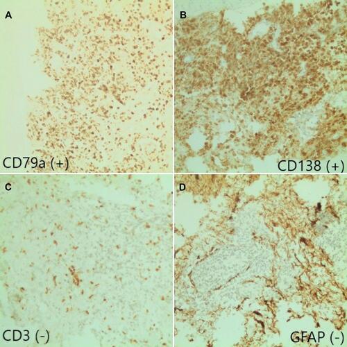 Figure 2 Immunohistochemistry results: (A) CD79a (+); (B) CD138 (+); (C) CD3 (-); (D) GFAP (-).