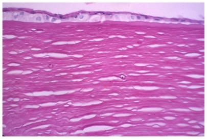 Figure 3 Stromal acanthamoebal cyst. PAS X 400.