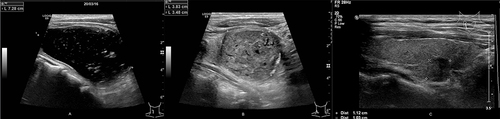 Figure 1 The left solid cyst of the thyroid gland was injected with 10mL of lauromacrol into the capsule in two separate injections, each retained for 5 minutes, and 8mL of lauromacrol injection was extracted, and the rest was retained in the capsule. Reexamination at 3 months after surgery showed that the left solid cyst was reduced, and reexamination at 6 months after surgery showed significant reduction compared with that at 3 months. (A) Laurosinol injection therapy for left solid cystic thyroid nodule. (B) Left thyroid cyst solid nodule laurosinol treatment 3 months after surgery. (C) Left thyroid cyst solid nodule laurosinol treatment 6 months after surgery.