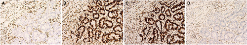 Figure 1 Colorectal adenocarcinoma showing loss of MLH1 (A) and PMS2 (D). The MLH1 and PMS2 proteins are expressed in the proliferating stromal cells. The MSH2 (B) and MSH6 (C) are expressed in the tumor cells and the stromal cells. Cases from Moffitt Cancer Center, Tampa, FL, USA.