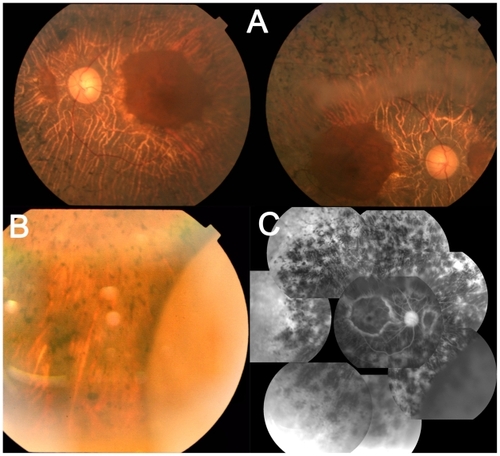 Figure 1 Photographs of a 81-year-old woman with retinitis pigmentosa. A) Fundus photographs show bilateral retinal arteriolar narrowing and intraretinal pigment deposition (bone spicule pigmentation) in both eyes, left: left eye, right: right eye. B) A fundus photograph of the right eye using a slit-lamp examination shows a detached retina in the nasal periphery. C) Fluorescein angiography images of the right eye show a hyperfluorescence due to atrophy of retinal pigment epithelium and hypofluorescence in the detached area.