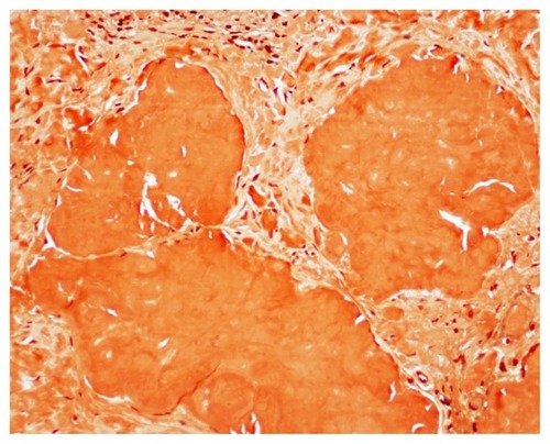 Figure 2 Congo red stain demonstrating orange-red deposits of amyloid.
