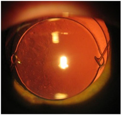 Figure 2 The slit-lamp retroillumination photo of PCO in eye with tilted IOL and one haptic located in the ring gap.