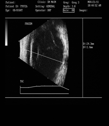 FIGURE 2  USG Bscan showing retinal detachment in right eye.