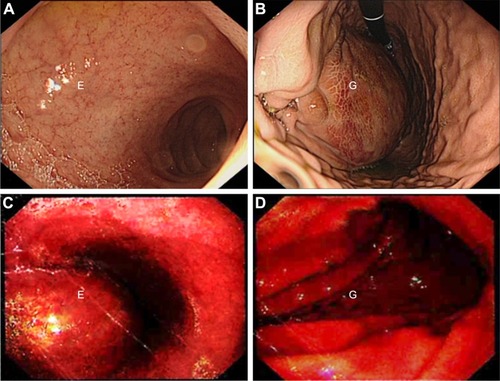 Figure 2 Gastroscopy images. (A, B) After admission, gastroscopy showed a mass with a smooth surface causing a partial obstruction of the lower esophagus and stomach fundus. (C, D) The day before admission, gastroscopy showed a mass with a smooth surface causing partial obstruction of the lower esophagus and a normal stomach fundus.