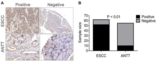 Figure 1 HDAC1 expression in human ESCC and ANTT. (A) HDAC1 immunohistochemical staining in ESCC cells and adjacent non-tumor tissues (ANTTs) (20×). (B) Statistical analysis of HDAC1-positive expression in ESCC and ANTT.