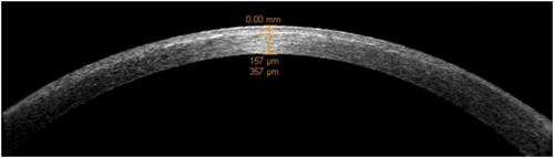 Figure 6 Anterior segment optical coherence tomography (AS-OCT) of a patient that underwent combined photorefractive keratectomy and corneal crosslinking for the correction of his refractive error showing the depth of the demarcation line.