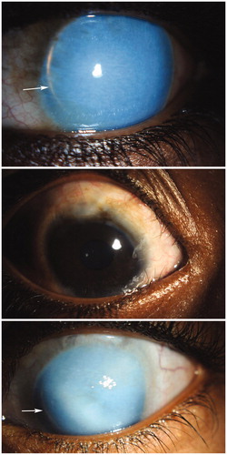 FIGURE 1. Top. Case one: Note the diffuse corneal haze, aniridia and lens edge (arrow). Middle. Case two: Photograph showing large clear corneas and normal iris structure. Bottom. Case three: Note diffuse corneal edema, aniridia and edge of clear lens (arrow).