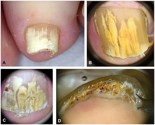 Figure 7. Dermoscopy of onychomycosis. A, Fringed proximal margin of the onycholysis. B, Blurred yellow-orange-brown nail discoloration in longitudinal striae (the fading mimics Aurora Borealis). C, Distribution of the discoloration in longitudinal striae or round areas. D, Ruin-like appearance of the subungual scales that are white-yellow-orange in color. Photographs courtesy of Dr Maria Bianca Piraccini [Citation34].